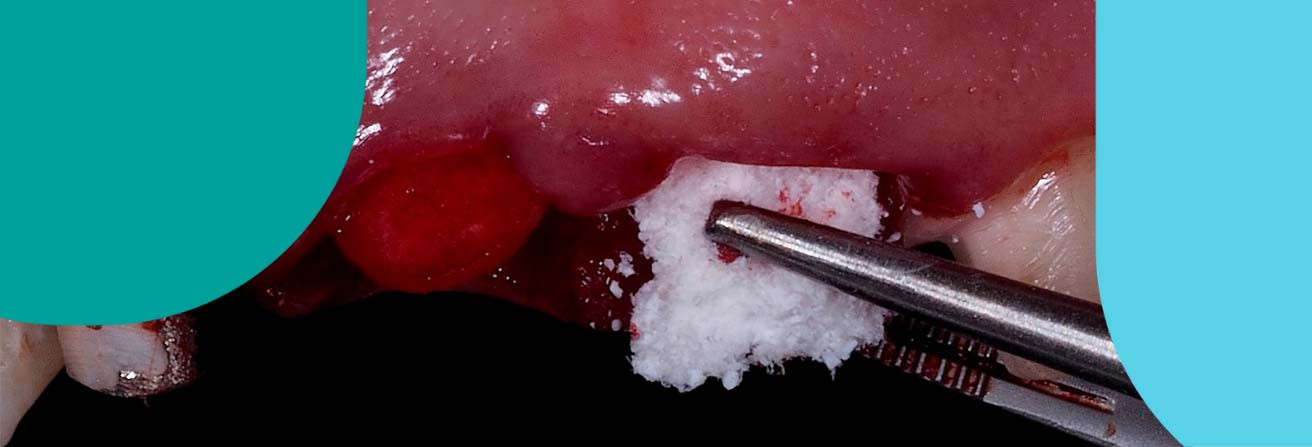 curs cirurgia implantològica dental