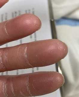 Manifestacions clíniques del Sd dits