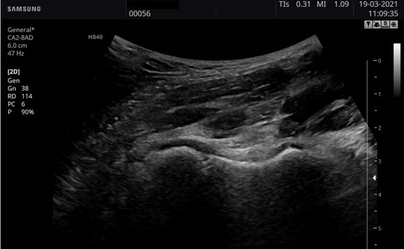 Imatge ecogràfica en Mode B (2D)