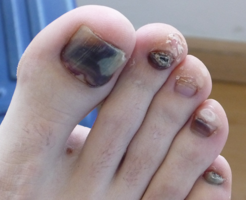 hematoma a les ungles